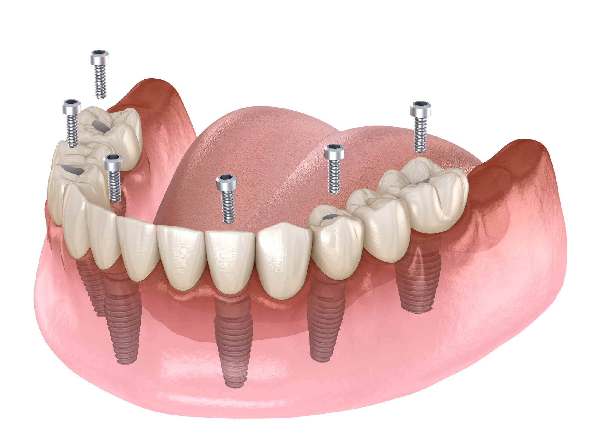 Is Getting All-On-4® Dental Implants Painful?