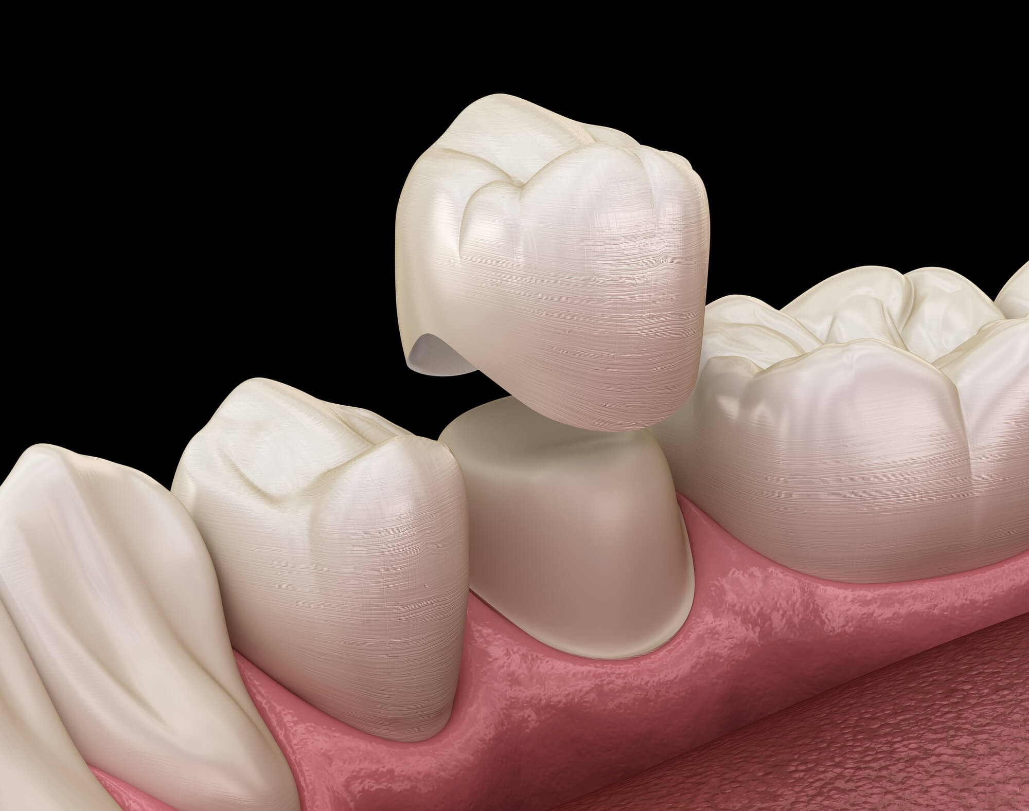 Is a Broken Crown a Dental Emergency?