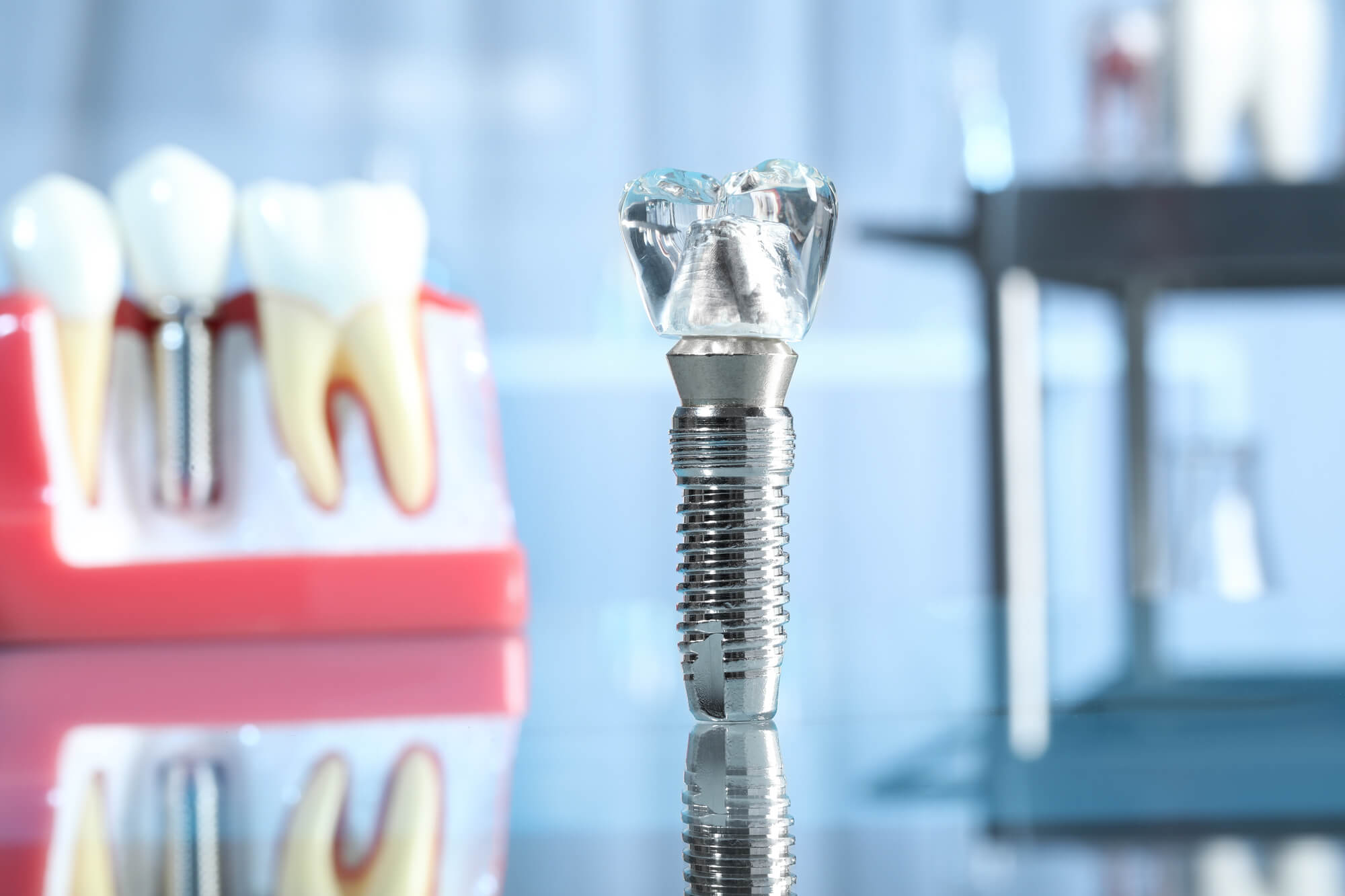 How to Properly Take Care of Your Dental Implants