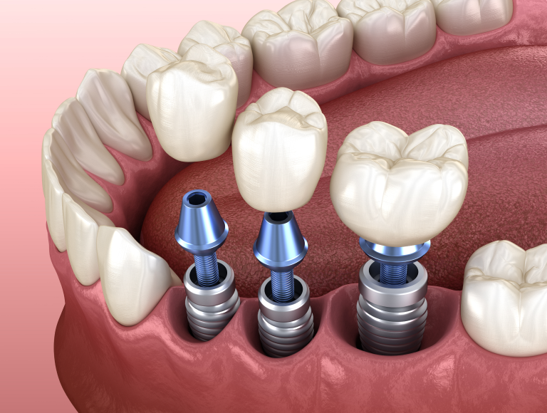 Multiple Teeth Replacement