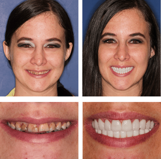 Before and after picture of patient with stained teeth that were improved by the Jupiter Dentistry team.