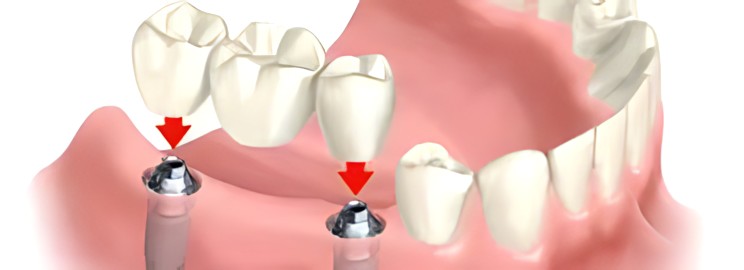 types of dental bridges