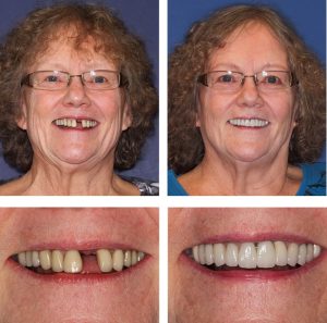 Before and after picture of patient with missing teeth that were restored by the Jupiter Dentistry team.