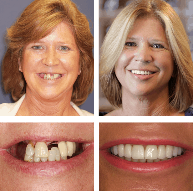 Before and after picture of patient with damaged teeth that were repaired by the Jupiter Dentistry team.