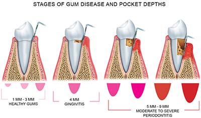 Visual graphic depicting different types of gum disease progressions.