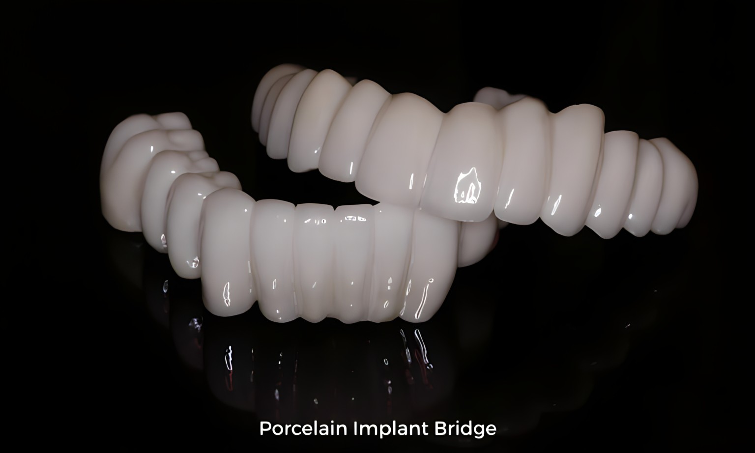 Porcelain implant dentures.