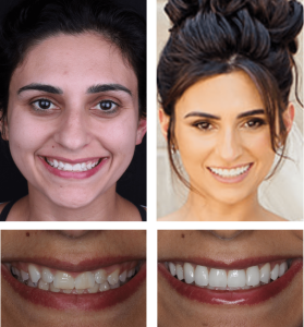 Veneers