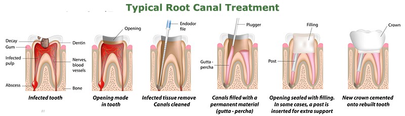 Graphic demonstrating the extent of a root canal procedure.