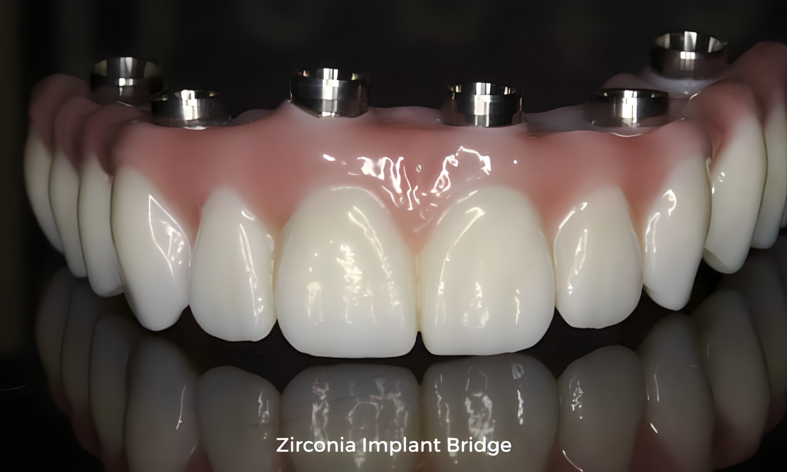 Zirconia implant dentures.