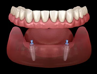 2-implant-overdenture