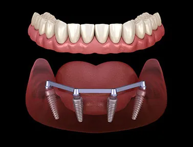 bar-overdenture