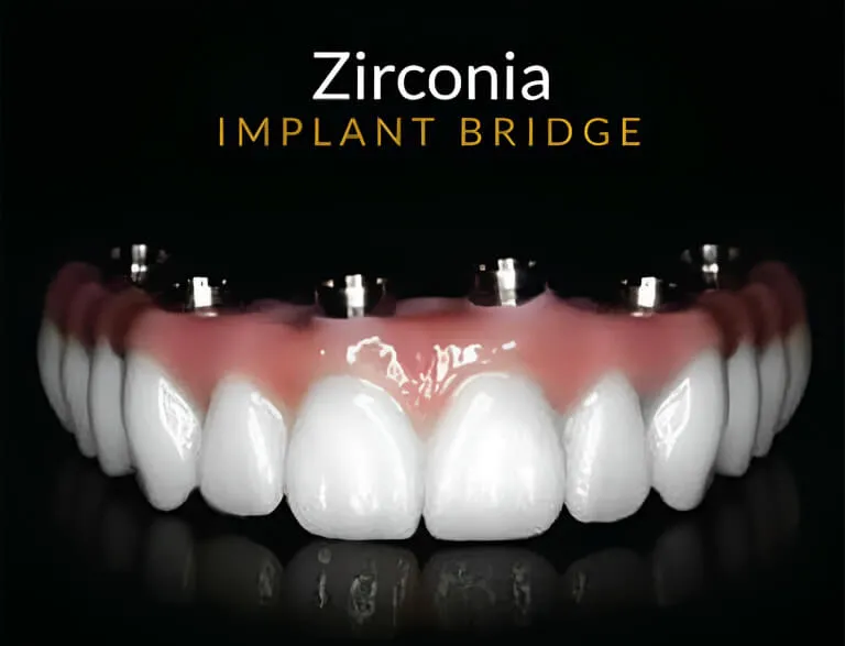 zirconia implant bridge