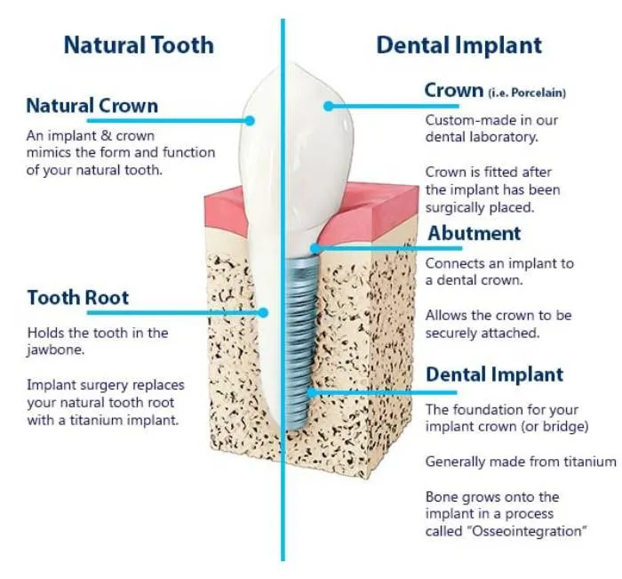 Implant