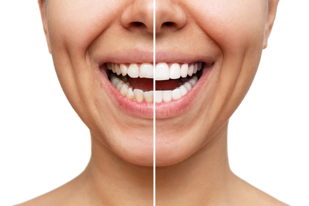 before and after teeth whitening at Jupiter Dentistry