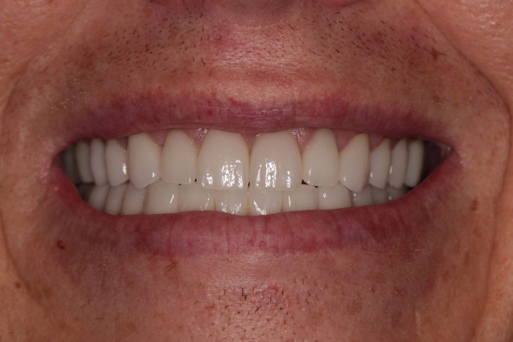 After-Smile-1-e1751298971390